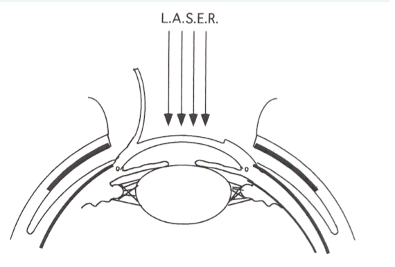 LASIK