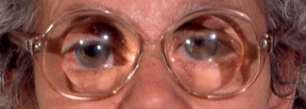 Patiente porteuse de lunettes d’aphake. 