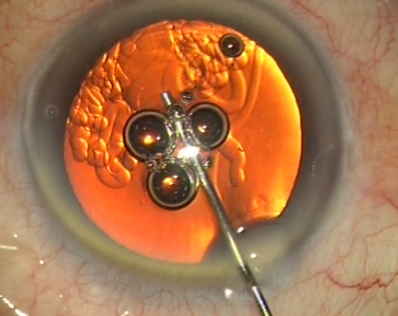 Injection de produit viscoélastique dans la chambre antérieure de l’œil