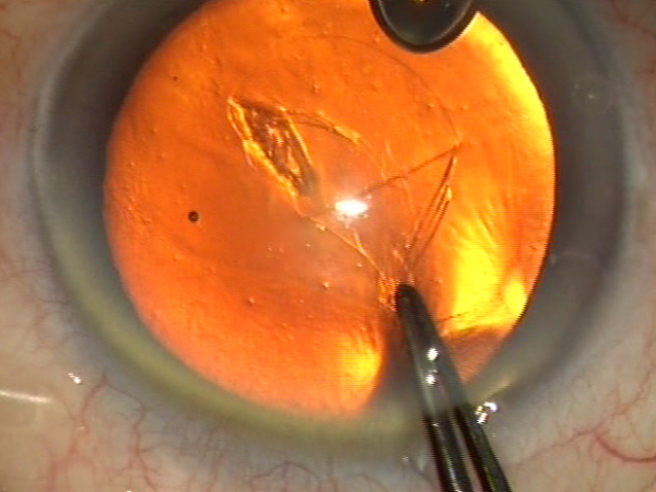 Trois étapes du capsulorhexis