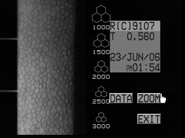 Endothélium cornéen parfaitement sain, les cellules d’aspect polygonal ressemblent à une mosaïque posée à la face postérieure de la cornée. Densité cellulaire supérieure à 2500.